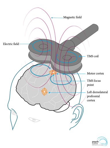 Transcranial-magnetic-stimulation-TMS