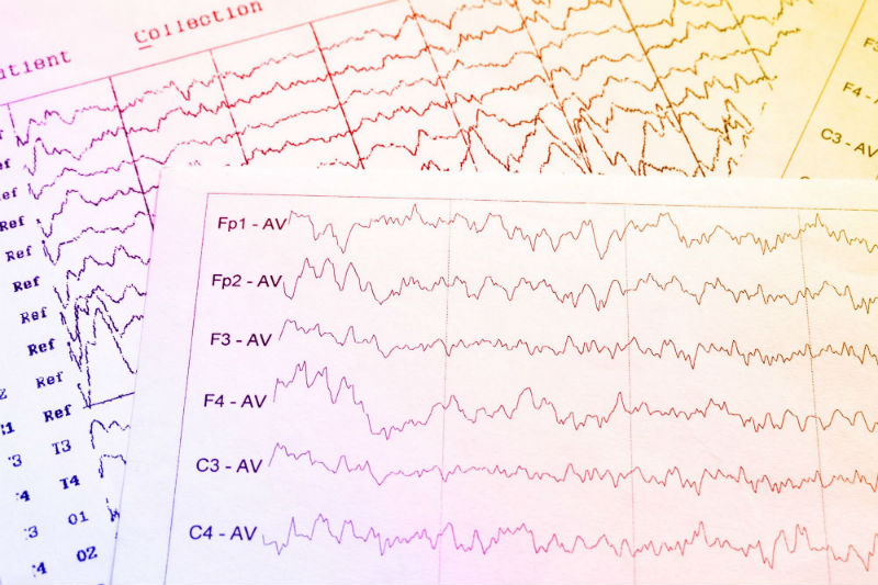 EEG-electrophysiological_SH_717274453